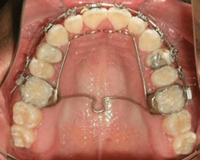 ESTAS SON IMAGEN, 4 Y 5 Tratamientos para la corrección de habito de lengua.