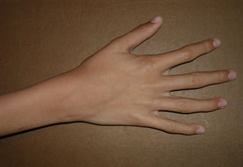 Figura 1 Aracnodactilia