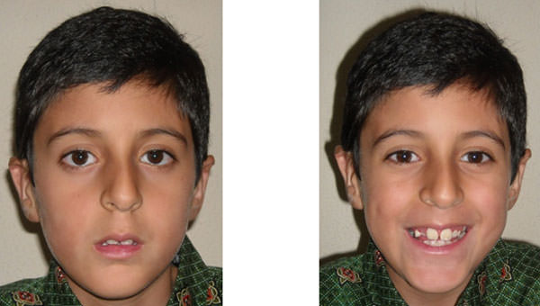 Figuras 2 y 3 Fotografías extraorales de frente y sonrisa.