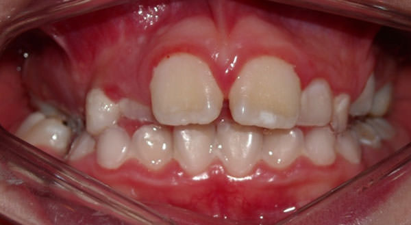 Figura 6 Fotografía intraoral de frente