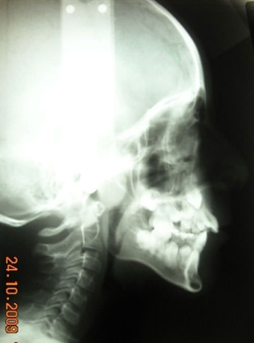 Figura 11 Radiografía cefálica lateral.