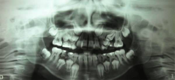 Figura 12 Radiografía panorámica.