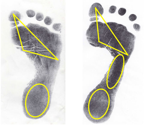 Zonas de apoyo plantar normal / zonas de apoyo plantar en paciente clase II