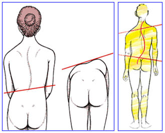 Fig. 6 Desviaciones en la columna. Tomado de Quiropraxis y posturología. www.tripod.com