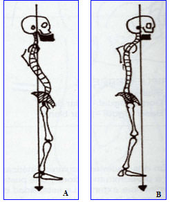 Fig.11 A - mesiorrelación / B - distorrelación. Tomada de Ohanian M. Fundamentos de la ortopedia dento-maxilo-facial
