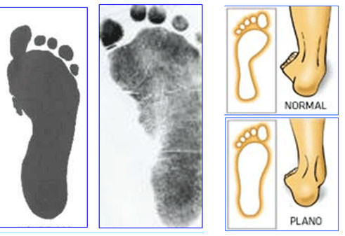 Fig.14 Pie plano grado 1 / Pie plano