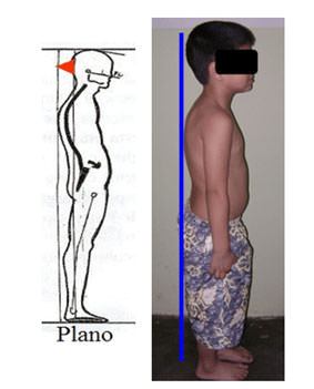 Fig.15 Niño con pie plano grado I y protrusión mandibular