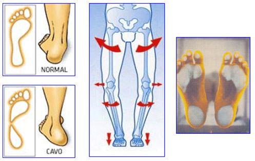 Fig.16 Pies cavos