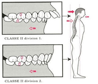 Fig.18 Postura de pacientes con clase II. Tomado de Tomada de Quiropraxis y posturología www.tripod.com