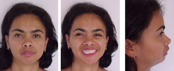Fig. 1- 3 Fotografías Extraorales