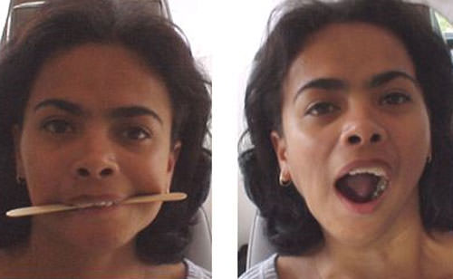 Fig. 4 y 5 Fotografías extraoraleds