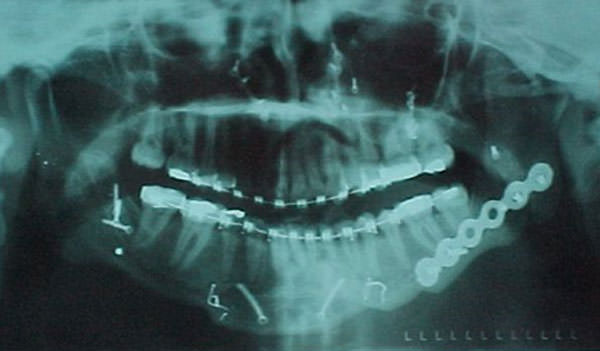 Fig. 14 Radiografía panorámica post-quirúrgica, se observan múltiples elementos de fijación y osteosíntesis