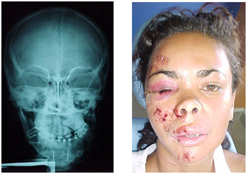 Fig. 24 y 25 Radiografía postero-anterior y fotografía frontal extraoral mostrando las lesiones producto de accidente en bicicleta