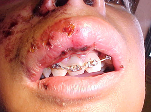 Figura 26 "Close up" de la zona peribucal mostrando escoriación y evidente inflamación del labio superior con pérdida del incisivo lateral superior izquierdo.