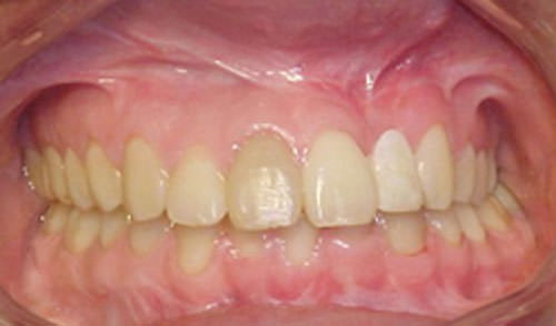 Figura 30 Fotografía intraoral de frente final.