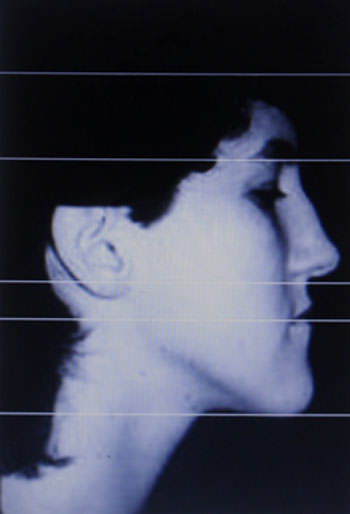 Figure 2 An example of a patient with an excessive lower facial height.