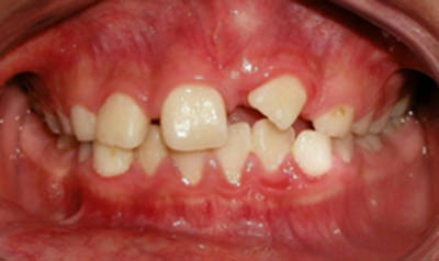 Figura 3 Dentición mixta
