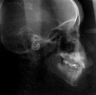 Figura 8 Radiografía lateral de cráneo