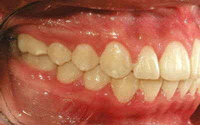 Figura 21 Lado derecho