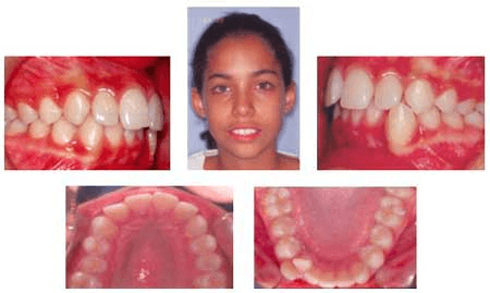 Figura 1 Paciente femenino de 11 años de edad, origen latino, padre español y madre mulata india nativa, con maloclusión clase I, apiñamiento moderado, incompetencia labial y biprotrusión.