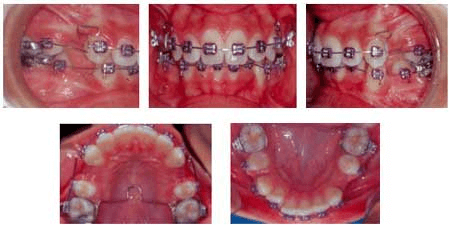 Figura 2 Biomecánica utilizada para la retracción de los segmentos anteriores superior e inferior, con anclaje moderado: