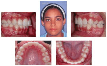 Figura 3 Después de 22 meses de tratamiento, con extracción de los cuatro primeros premolares y cerrando los espacios utilizando la técnica de retracción en masa de los seis dientes anteriores con mecánica de anclaje moderado, se corrigen los problemas funcionales y estéticos del paciente.