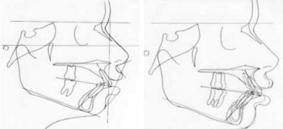 Trazado Pre-tratamiento / Superposición Pre y Post tratamiento