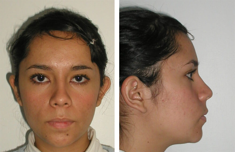 Fig. 1 y 2 - Inicial de frente / Inicial de perfil