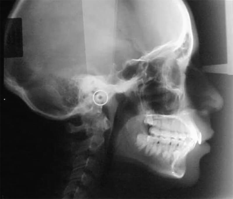 Fig. 3 Cefálica lateral inicio