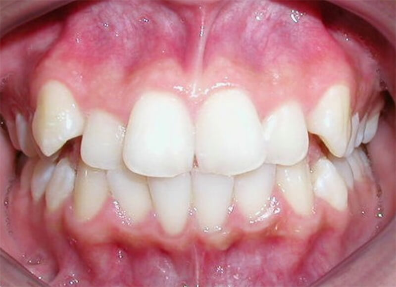 Fig. 4 Intraoral de frente inicio