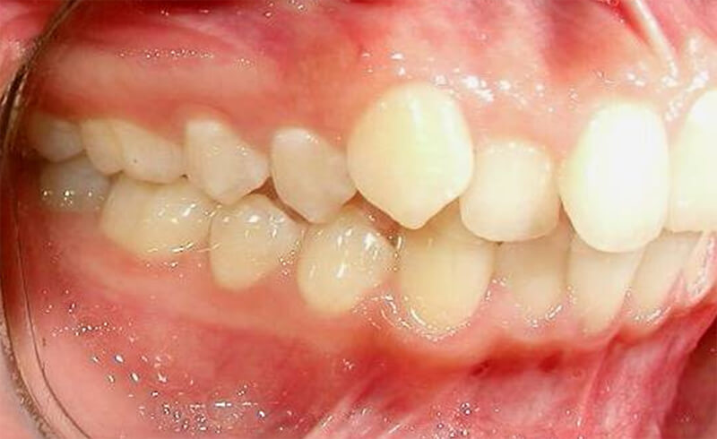 Fig. 5 Intraoral derecha inicio