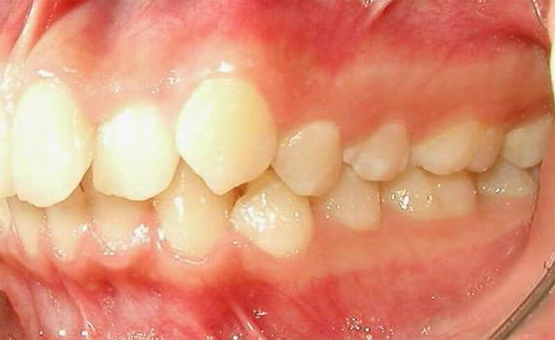 Fig. 6 Intraoral izquierda inicio