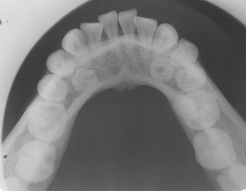 Fig. 8 Radiografía oclusal inferior