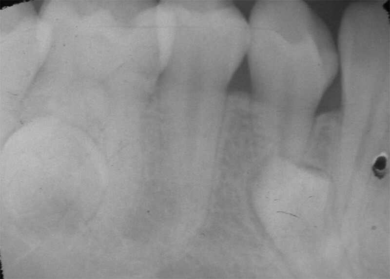 Fig. 9 Periapical inferior derecha