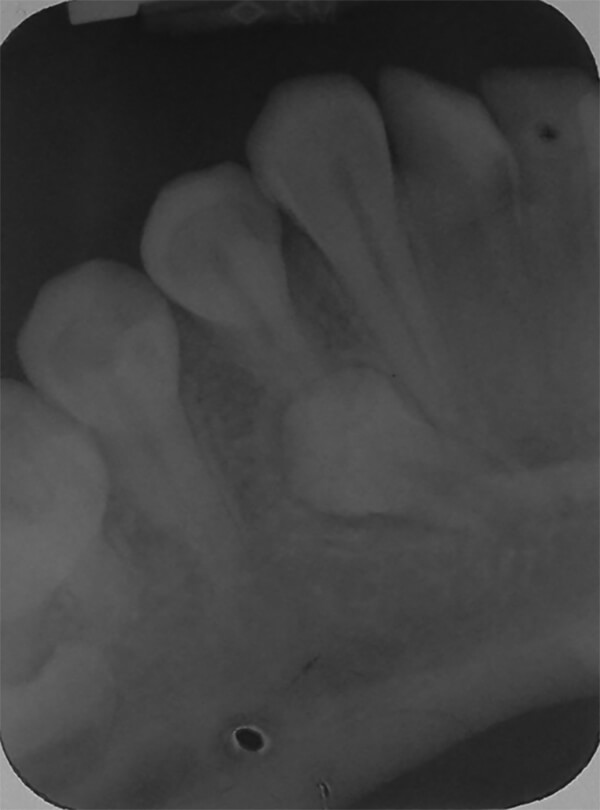 Fig. 10 Periapical inferior derecha