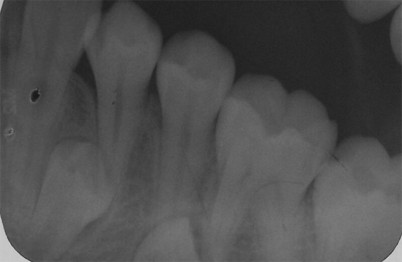 Fig. 11 Periapical inferior izquierda