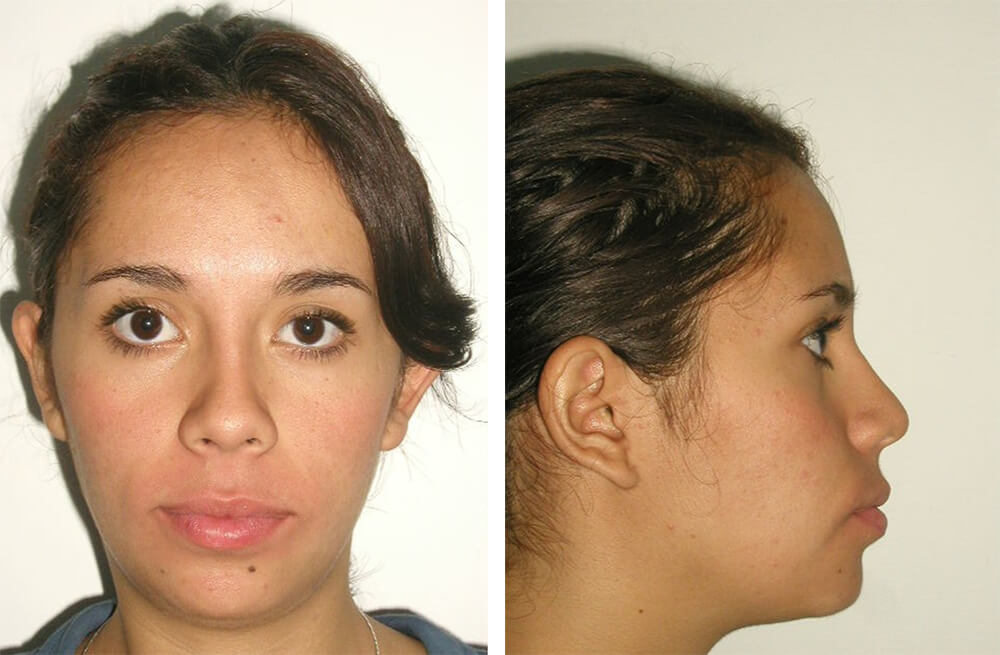 Fig. 12 y 13 Extraoral de frente Progreso / Extraoral de perfil progreso