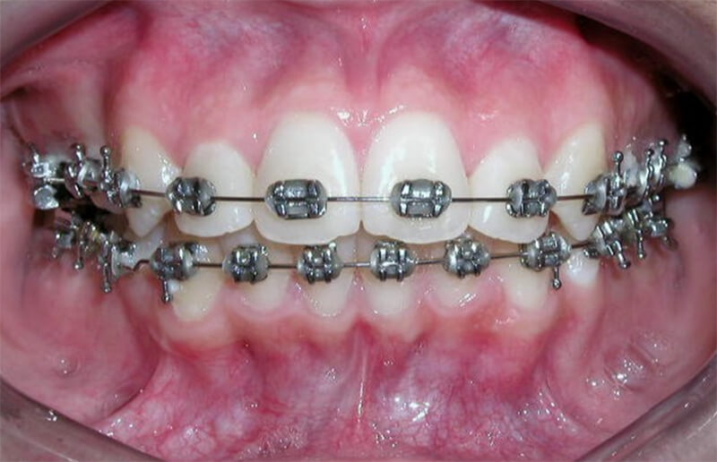 Fig. 14 Intraoral de frente progreso