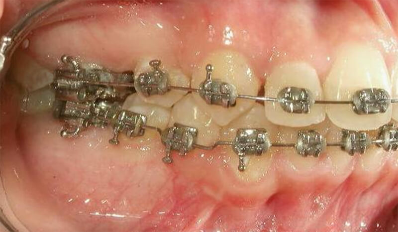 Fig. 15 Lateral derecha progreso