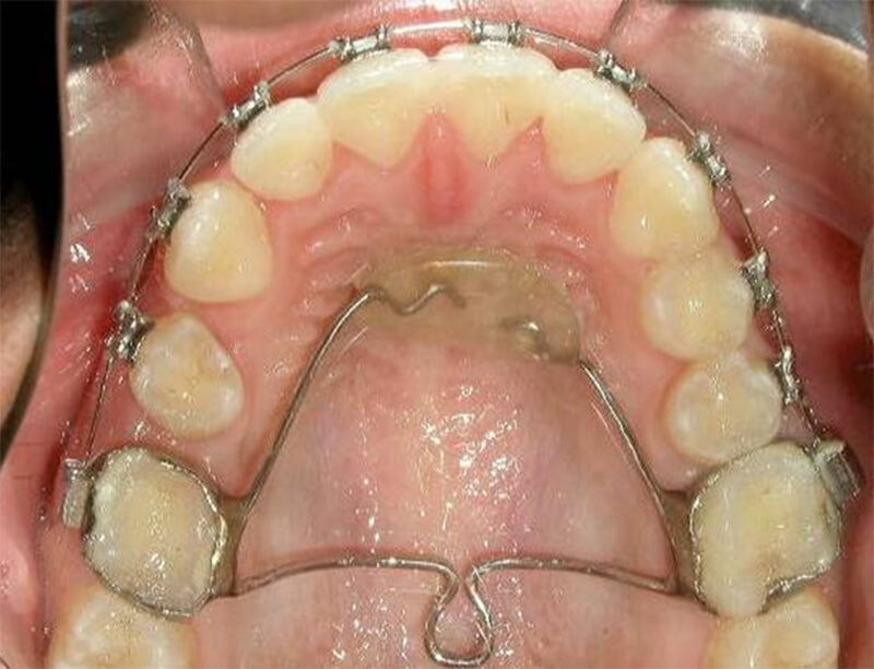 Fig. 17 Oclusal superior progreso