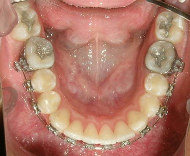 Fig. 18 Oclusal inferior de progreso