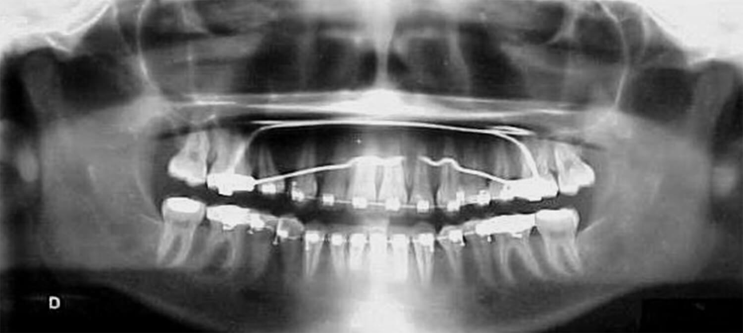 Fig. 20 Radiografía Panorámica de progreso