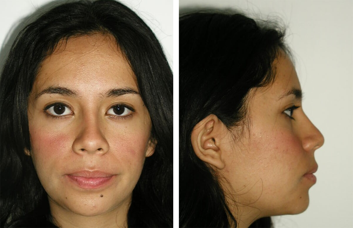 Fig. 21 y 22 - Extraoral frente final / Foto de perfil final