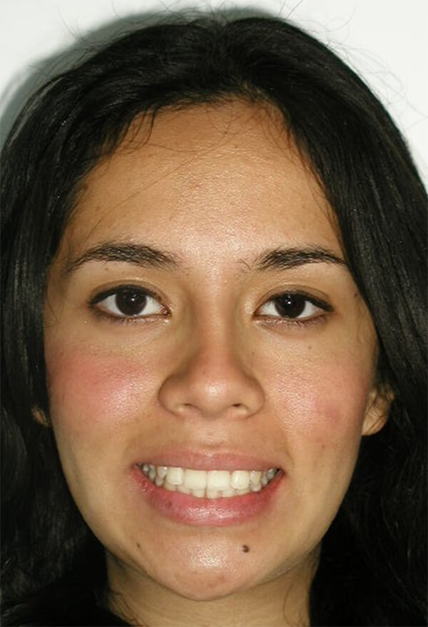Fig. 23 Extraoral de sonrisa final