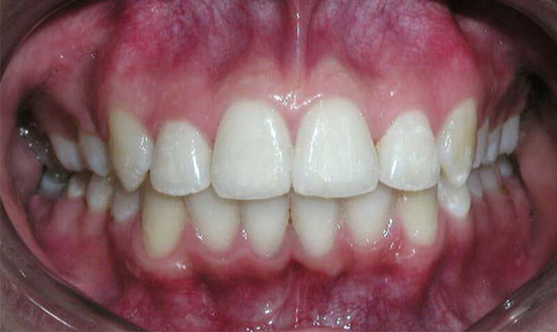 Fig. 24 Intraoral de frente final