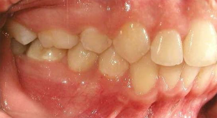 Fig. 25 Lateral derecha final