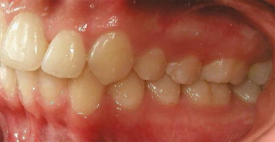 Fig. 26 Lateral izquierda final