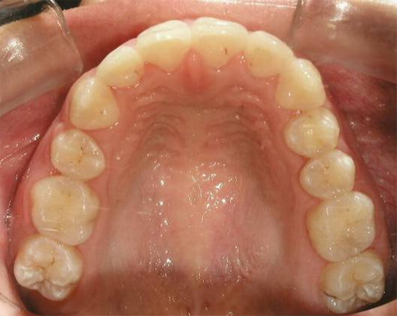 Fig. 27 Oclusal superior final