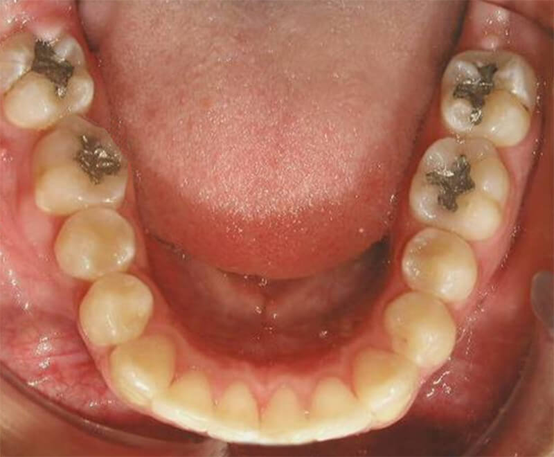 Fig. 28 Oclusal inferior final
