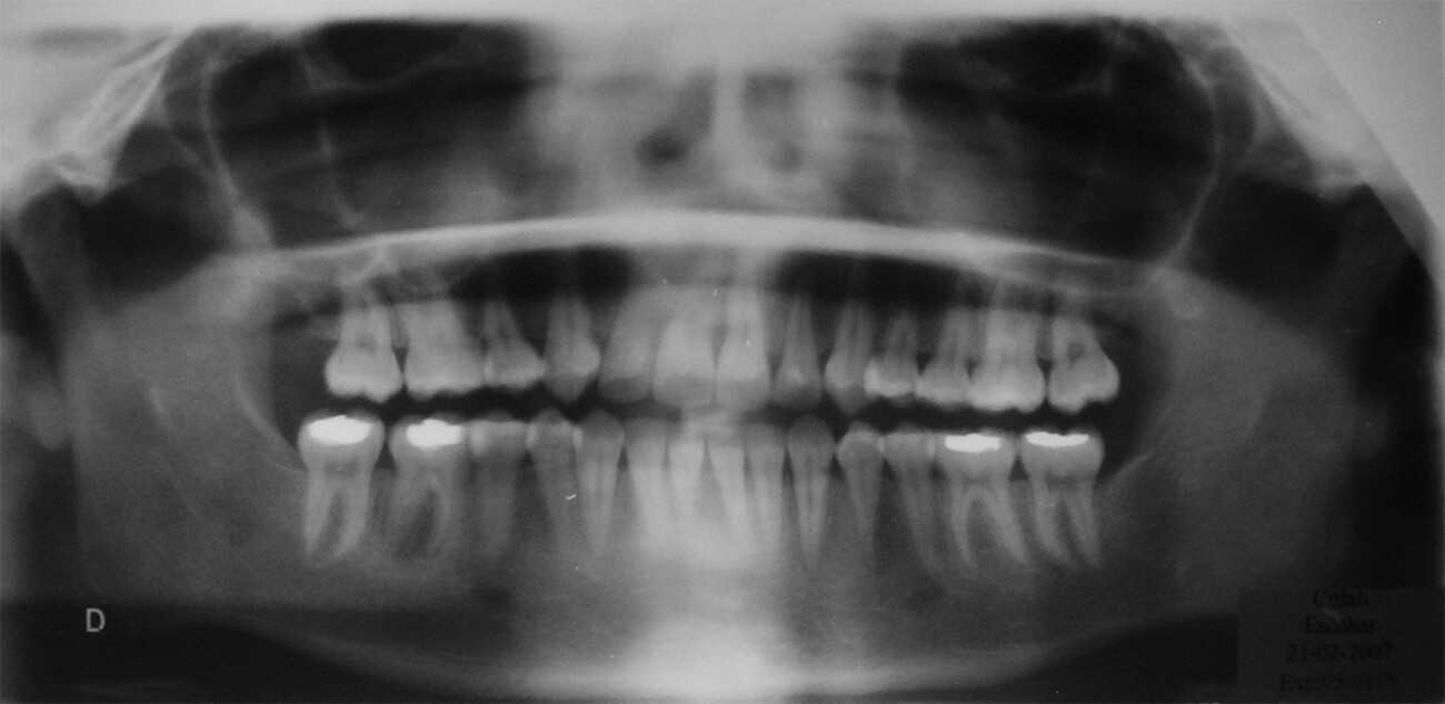Fig. 30 Radiografía panorámica final